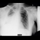 Pneumonia, lobectomy: X-ray - Plain radiograph