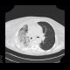 Pneumonia, lobectomy: CT - Computed tomography