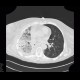 Pneumonia, lobectomy: CT - Computed tomography