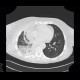 Pneumonia, lobectomy: CT - Computed tomography