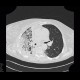 Pneumonia, lobectomy: CT - Computed tomography