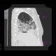 Pneumonia, lobectomy: CT - Computed tomography