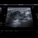 Tumorous infiltration of lymph node: US - Ultrasound