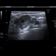 Tumorous infiltration of lymph node: US - Ultrasound