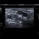 Tumorous infiltration of lymph node: US - Ultrasound