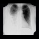 Pneumonia, consolidation: X-ray - Plain radiograph