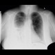 Pneumonia, consolidation: X-ray - Plain radiograph