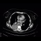 Pneumonia, consolidation: CT - Computed tomography