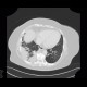 Pneumonia, consolidation: CT - Computed tomography