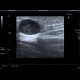 Tumorous infiltration of lymph node: US - Ultrasound