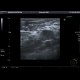 Tumorous infiltration of lymph nodes: US - Ultrasound