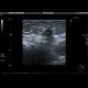 Tumorous infiltration of lymph nodes: US - Ultrasound