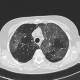 Influenza, atypical pneumonia, HRCT: CT - Computed tomography