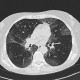 Influenza, atypical pneumonia, HRCT: CT - Computed tomography