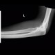 Fracture of head of radius, fat pad sign, sail sign: X-ray - Plain radiograph
