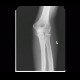 Fracture of head of radius, fat pad sign, sail sign: X-ray - Plain radiograph