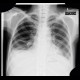 Inspirum and expirium: X-ray - Plain radiograph