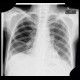 Inspirum and expirium: X-ray - Plain radiograph