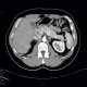 Insulinoma, before operation: CT - Computed tomography