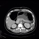 Insulinoma, after operation: CT - Computed tomography