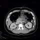 Insulinoma, after operation: CT - Computed tomography