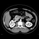 Insulinoma of pancreas: CT - Computed tomography