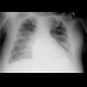 Interstitial lung edema: X-ray - Plain radiograph