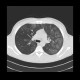 Intraalveolar hemorrhage, case 2: CT - Computed tomography