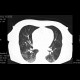 Intraalveolar hemorrhage, case 3: CT - Computed tomography