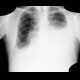 Pleural effusion, pneumothorax, PNO, inverstion of hemidiaphragm: X-ray - Plain radiograph