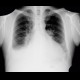 Pleural effusion, pneumothorax, PNO, inverstion of hemidiaphragm: X-ray - Plain radiograph