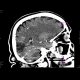 Ischemic focus in brain: CT - Computed tomography