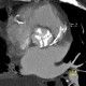 Aortic valve, calcified aortic valve: CT - Computed tomography