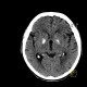 Calcification in basal ganglia: CT - Computed tomography