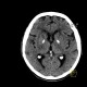 Calcification in basal ganglia: CT - Computed tomography