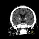 Calcification in basal ganglia: CT - Computed tomography