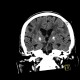 Calcification in basal ganglia: CT - Computed tomography