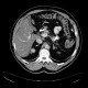 Calcification in adrenal gland: CT - Computed tomography