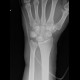 Calcification in triangular fibrocartilage complex, TFCC: X-ray - Plain radiograph