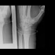 Calcification in triangular fibrocartilage complex, TFCC: X-ray - Plain radiograph