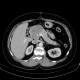Carcionoid, pancreas, head of pancreas, calcification: CT - Computed tomography