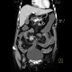 Carcinoid of ileum and mesentery, liver metastasis, CT enterography: CT - Computed tomography