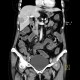 Carcinoid of ileum and mesentery, liver metastasis, CT enterography: CT - Computed tomography