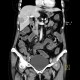 Carcinoid of ileum and mesentery, liver metastasis, CT enterography: CT - Computed tomography