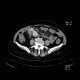 Carcinoid of ileum and mesentery, liver metastasis, CT enterography: CT - Computed tomography