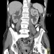 Peritoneal carcinosis, hydronephrosis: CT - Computed tomography