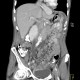 Peritoneal carcinosis, hydronephrosis: CT - Computed tomography