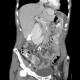 Peritoneal carcinosis, hydronephrosis: CT - Computed tomography