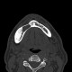 Keratocyst of mandible: CT - Computed tomography