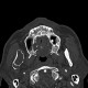 Keratocyst of mandible: CT - Computed tomography